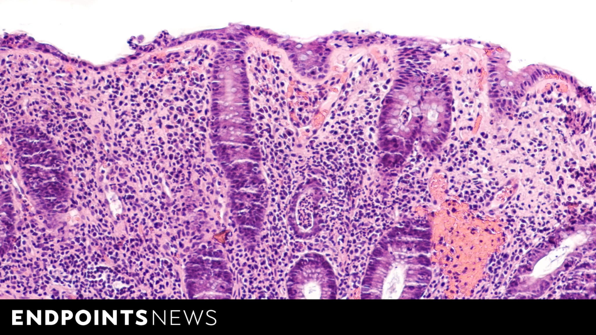 Sanofi, Teva bolster case for IBD drug with Phase 2 data, despite potential competition