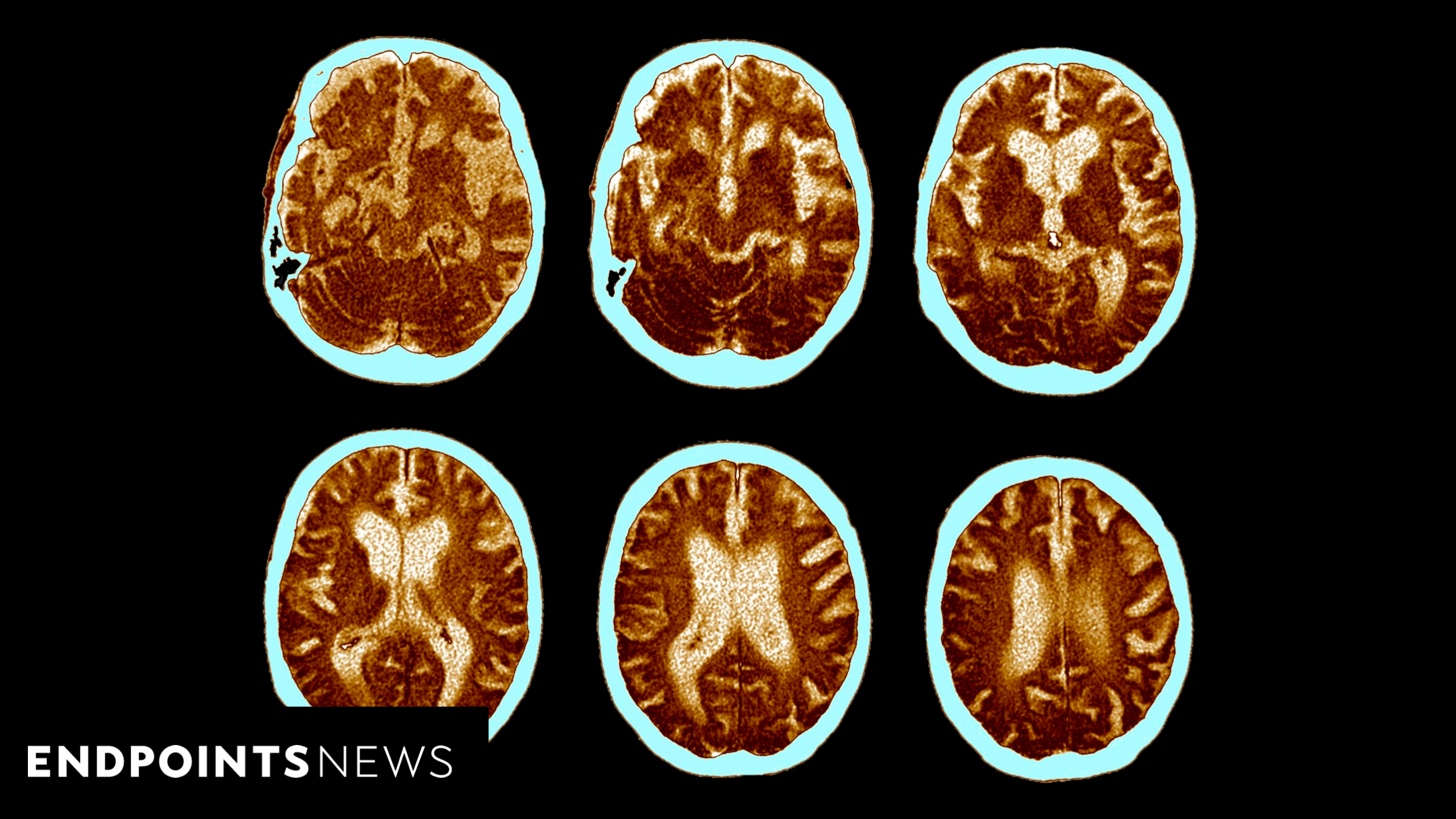 NIH To Work With 10x Genomics For Alzheimer’s Disease Brain Cell Atlas ...